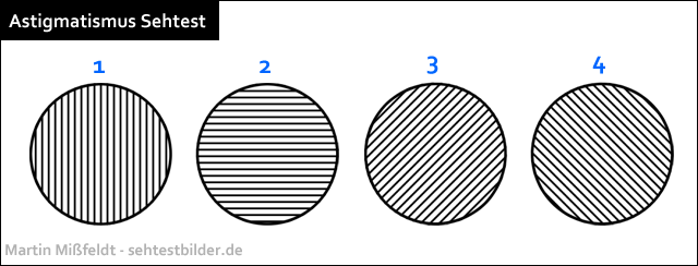 myopie astigmatismus beidseitig