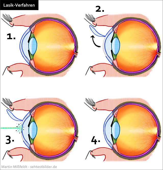 Lasik - Auge lasern Verfahren