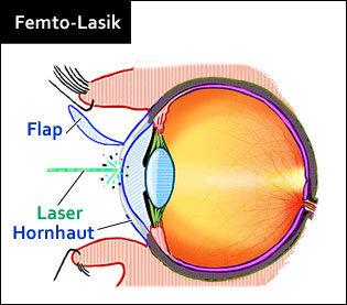 Femto-Lasik