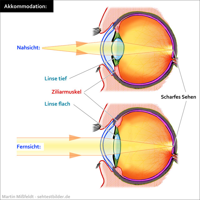 Akkommodation als Ursache Alterssichtigkeit