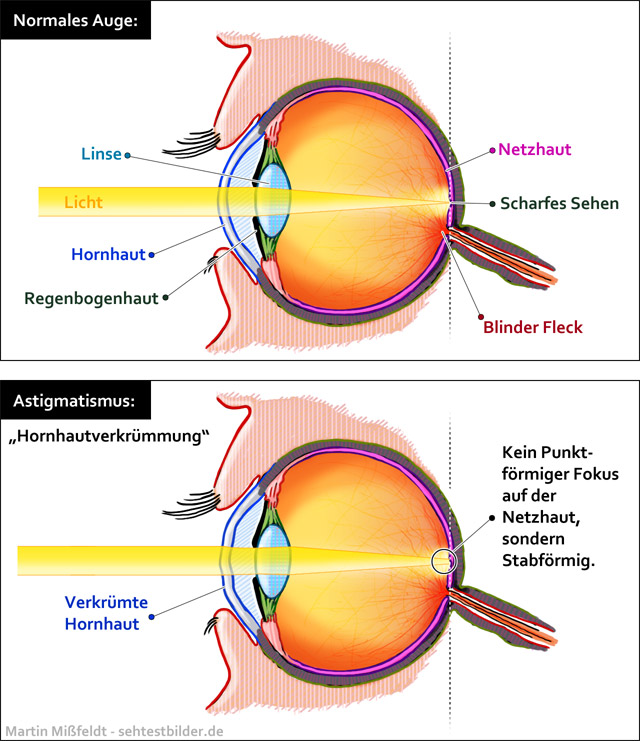 Astigmatismus (Auge)