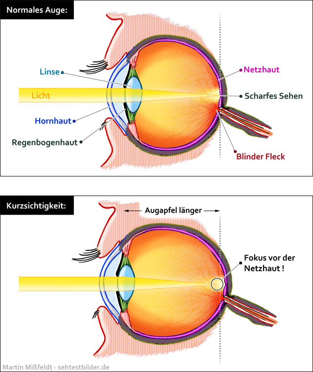 Kurzsichtigkeit