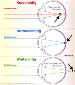 Sehschärfe: Kurzsichtigkeit - Weitsichtigkeit