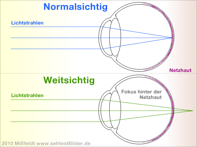 Was Bewirkt, Dass Kurzsichtigkeit Bei Erwachsenen