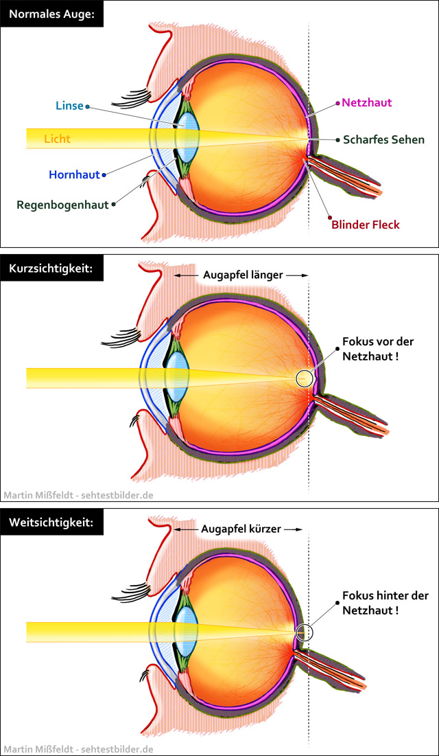 Kurzsichtigkeit und Weitsichtigkeit