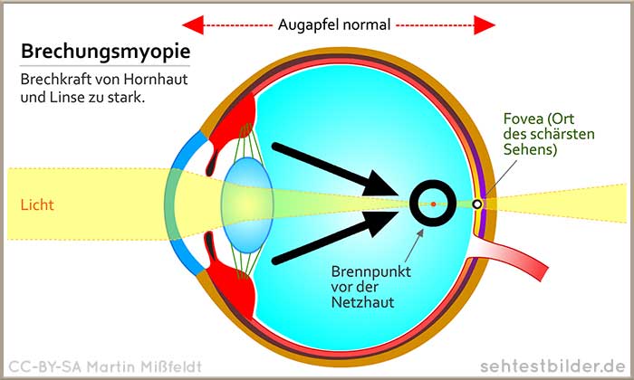 Brechungsmyopie