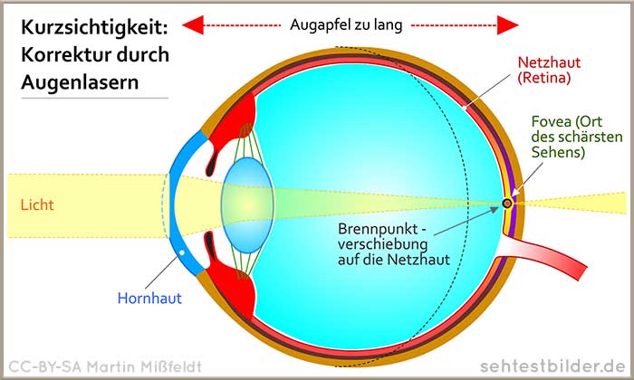 Kurzsichtigkeit lasern: Hornhaut wird verändert