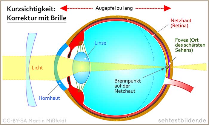 Brille bei Kurzsichtigkeit