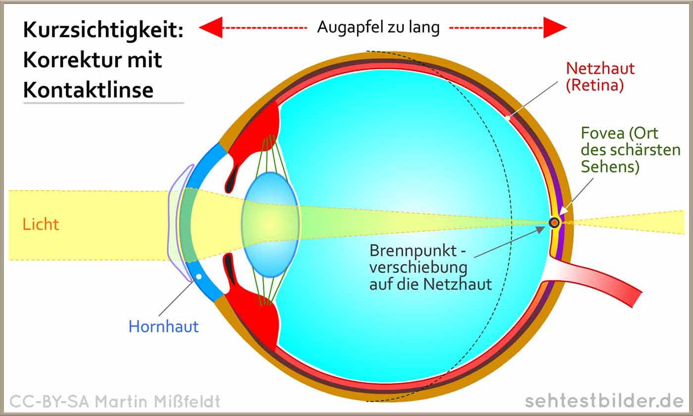 Umrechnen kontaktlinsen dioptrien Berechnen Sie
