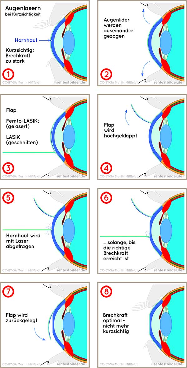 Kurzsichtigkeit lasern: Der Ablauf der Laser-OP