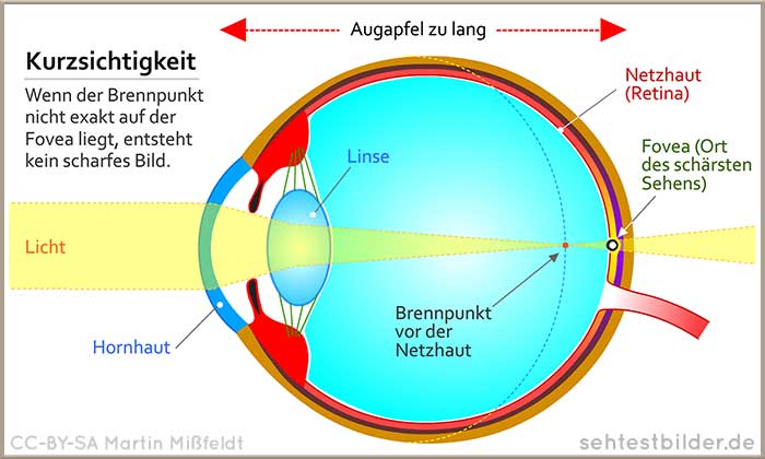 Kurzsichtigkeit (Myopie) - einfache Erklärung