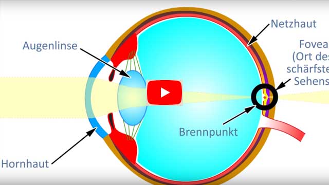 Was ist Kurzsichtigkeit? (Myopie)